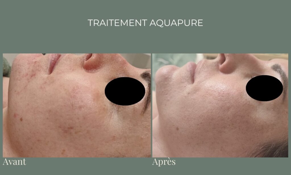 séance aquapure visage