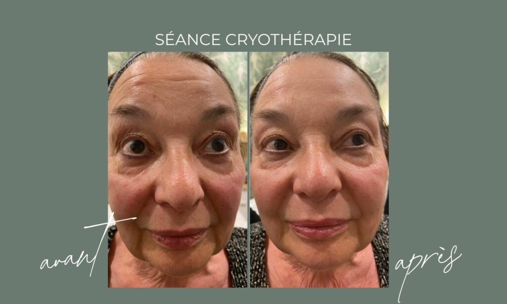 Séance cryothérapie visage - maeava beauté