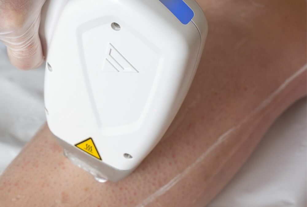 Épilation laser : ce qu&rsquo;il faut vraiment comprendre avant de se lancer