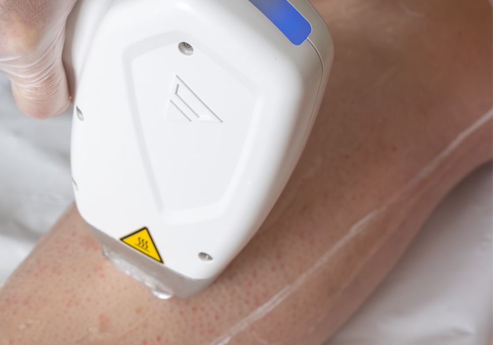 laser epilation definitive sainte genevieve des bois